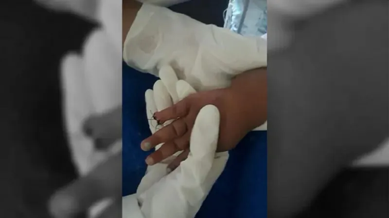 Menina que teve parte do dedo amputado passará por nova cirurgia