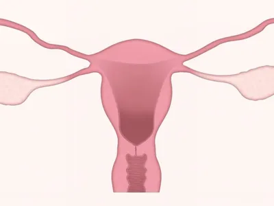 Câncer de ovário – sinais podem ajudar o diagnóstico desta doença silenciosa