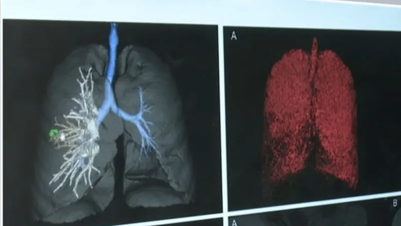 Pacientes reumáticos têm maior risco de desenvolver tuberculose