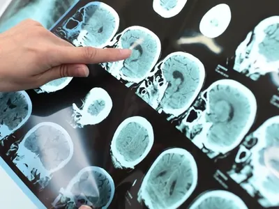 Remédio contra o Alzheimer: Entenda o tratamento anunciado pelos EUA