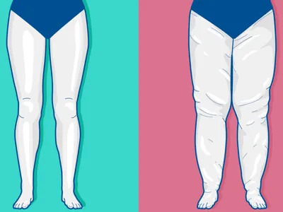 Lipedema: conheça a doença que provoca deformação e é confundida com obesidade