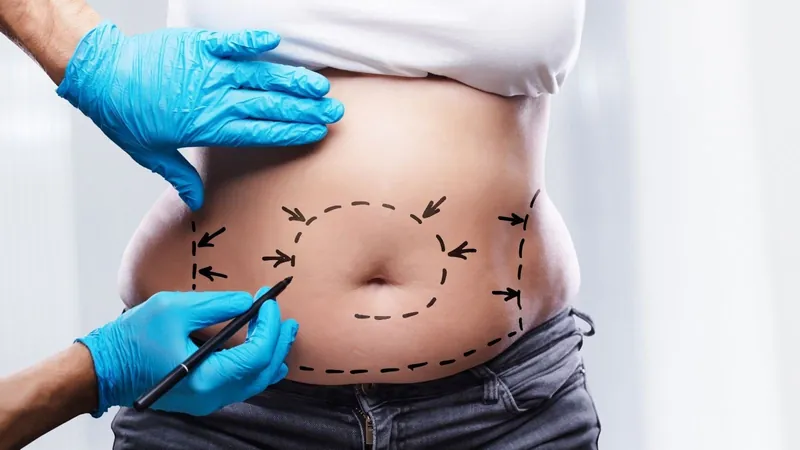 Cirurgia tem o objetivo de retirar gordura localizada