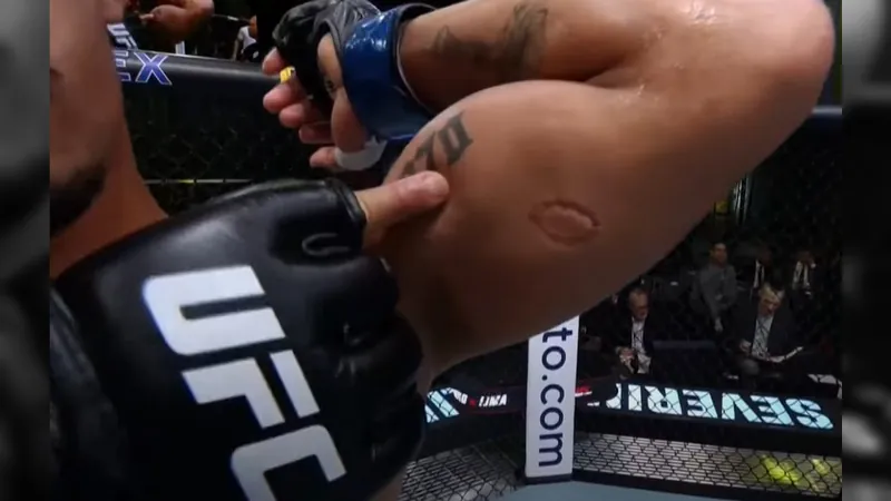 Braço de Andre Lima após levar mordida durante a luta, no UFC Vegas 89