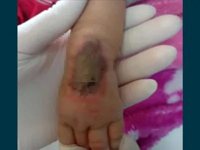 Bebê é internada com broquiolite, sofre lesão na mão e passa por cirurgia 