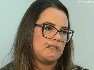 Mulher perde os lábios após procedimento estético com PMMA: "Não me reconheço"