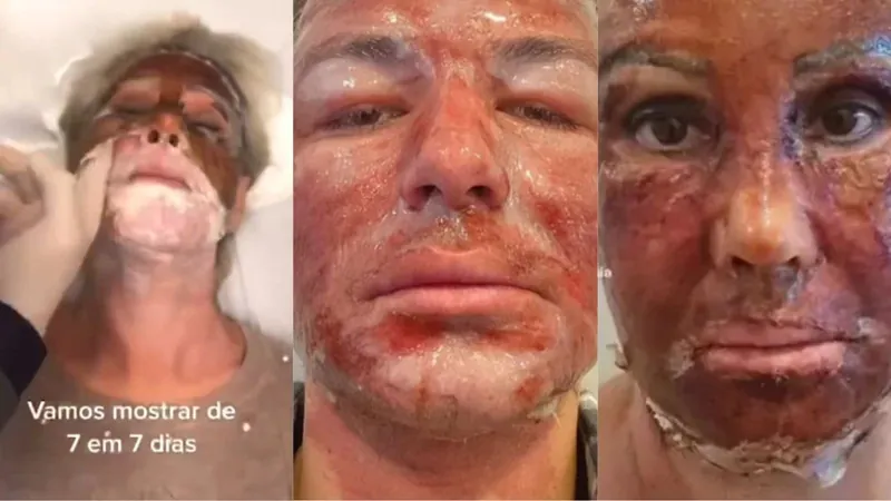 Saiba o que é peeling de fenol, procedimento que jovem morreu depois de fazer