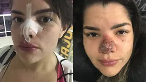 Jornalista teve nariz necrosado após complicações com procedimento estético