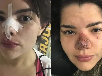 Jornalista teve nariz necrosado após complicações com procedimento estético