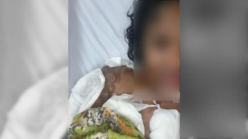 Jovem que foi atacada com óleo quente diz que agressão foi motivada por ciúmes