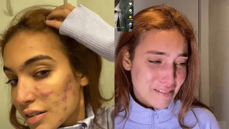 Vanessa Lopes tem crise de choro após desabafo sobre acne: "Me sinto um monstro"