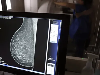 Cerca de 77 mil mulheres aguardam mamografia pelo SUS