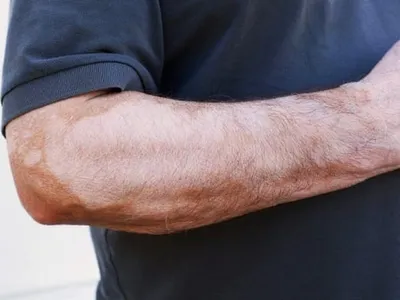 Pacientes que tratam vitiligo no Hospital Federal de Bonsucesso reclamam da falta de material